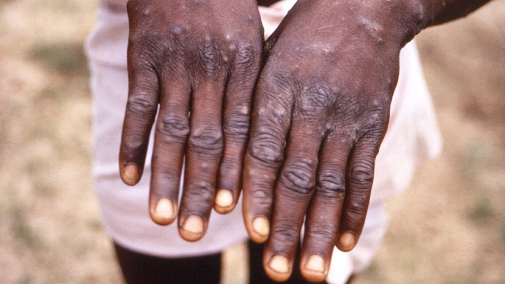 Congo Battles Growing Monkeypox Outbreak: New Strain Raises Concerns