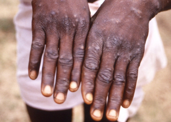 Congo Battles Growing Monkeypox Outbreak: New Strain Raises Concerns